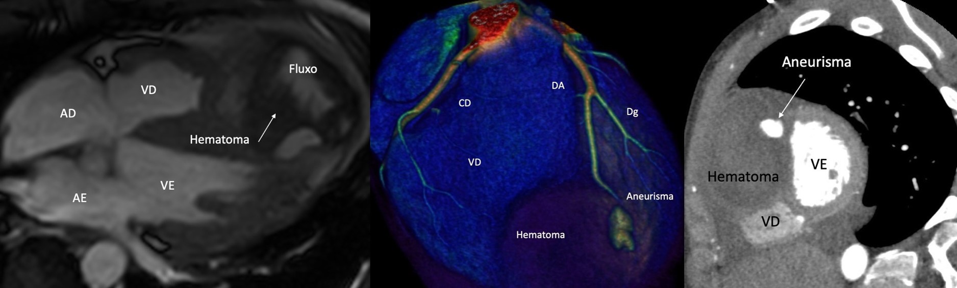 Ressonância magnética cardíaca: aneurisma de artéria descendente anterior